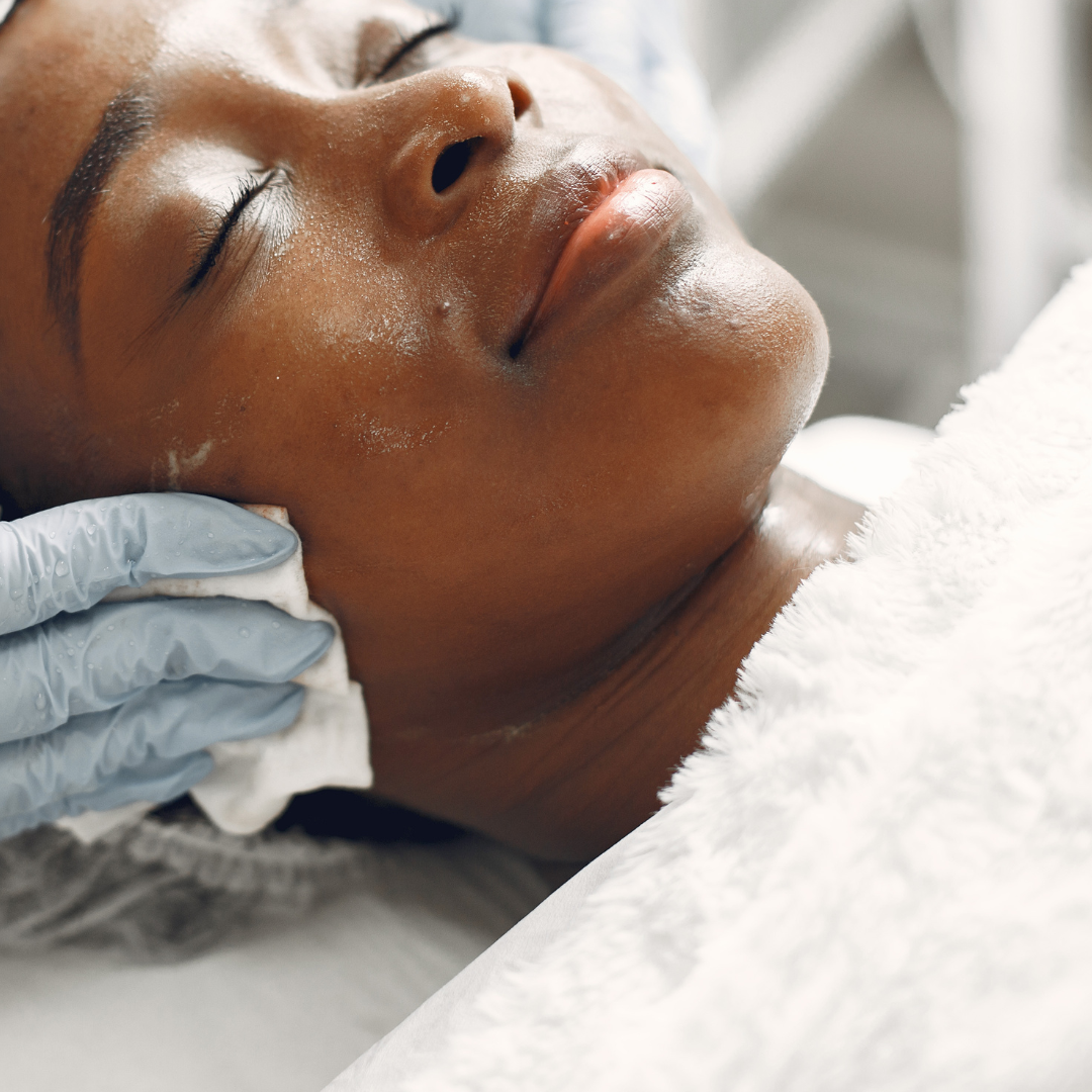 Chemical Peel