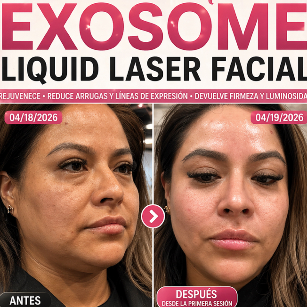 Exapeel Liquid Laser +Exoxomas at Beverly Beauty Skincare and spa in Chicago, IL