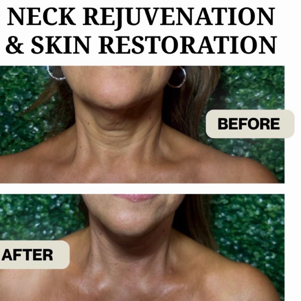 Skin Renewal Treatment at Beverly Beauty Skincare and spa in Chicago Il, IL