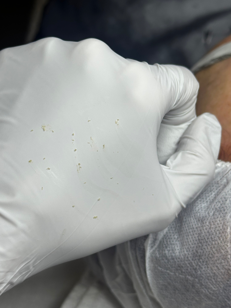 Acne balancing facial at Naked Skin Studio in Las Piedra, PR