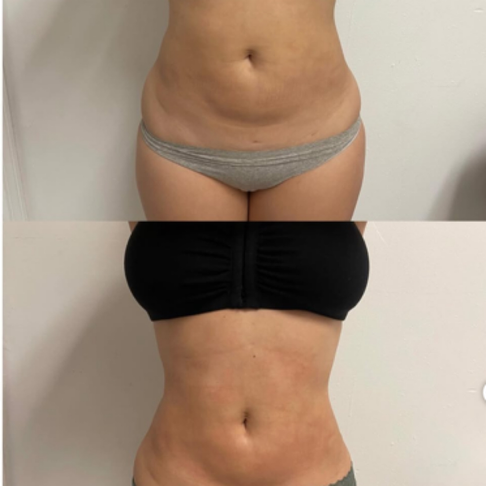 Body Sculpting & Contouring at ALEXIS BEAUTY SERVICES in Montgomery, AL