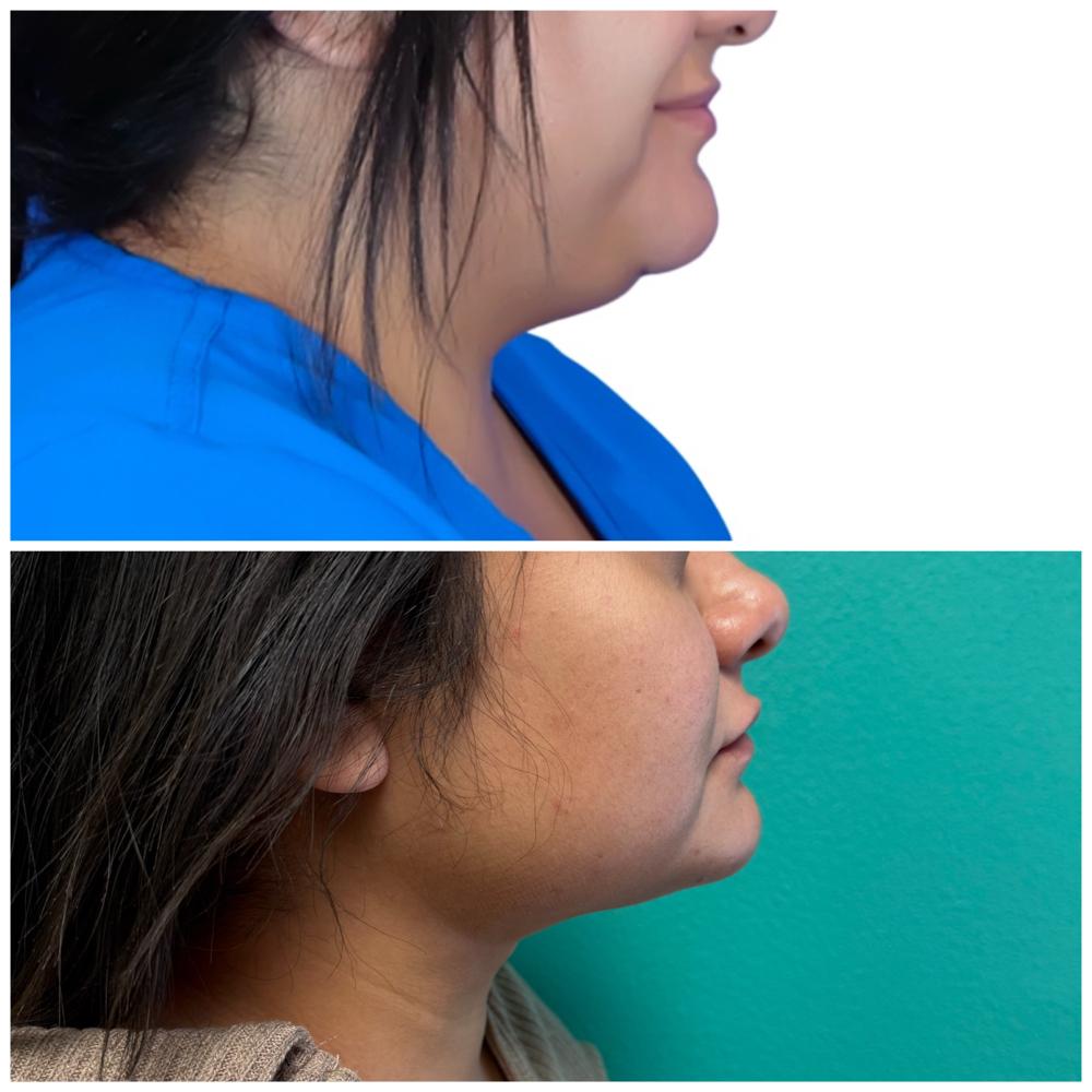 Chin Lipo Post Op Massage