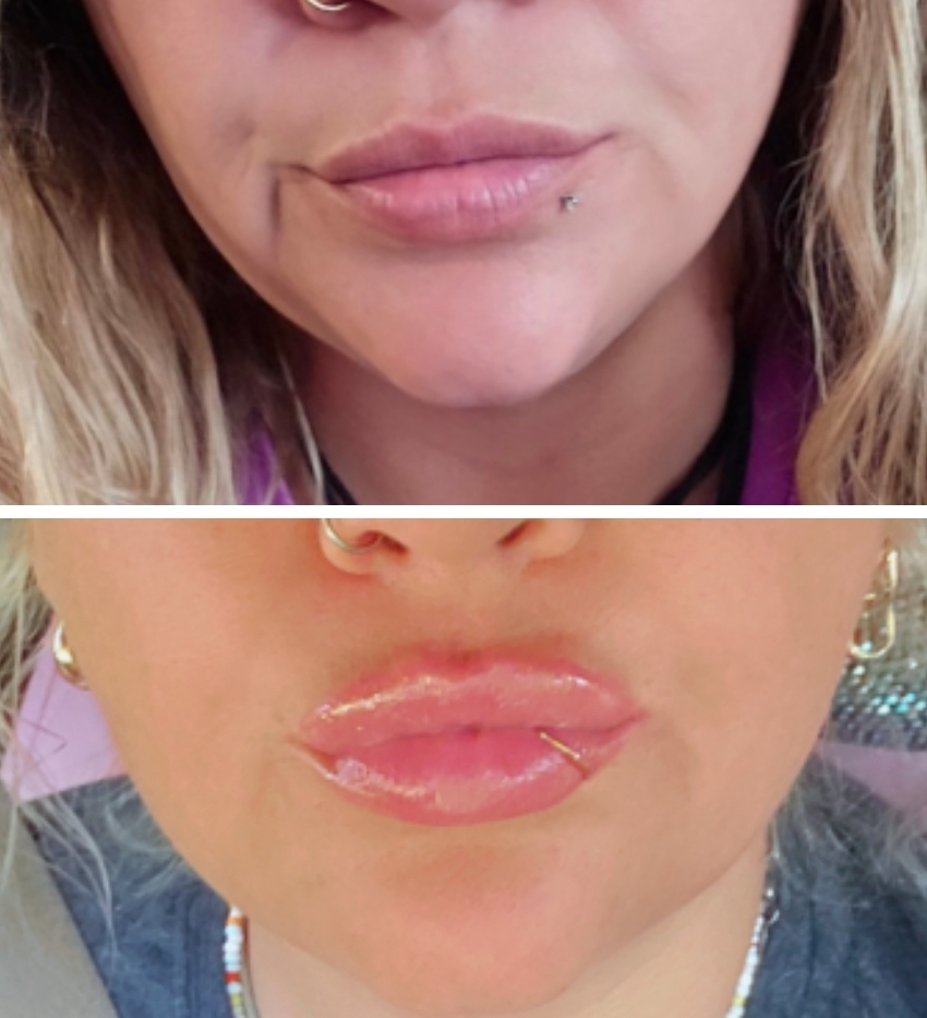 Hyaluronic Acid Lip Filler Bundle