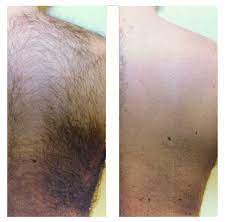 Laser Hair Removal / Full Back