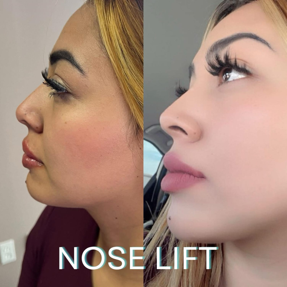 Tox-Famous Tinker Nose Lift💉 at BeautyHolic Aesthetics LLC in Lubbock, TX