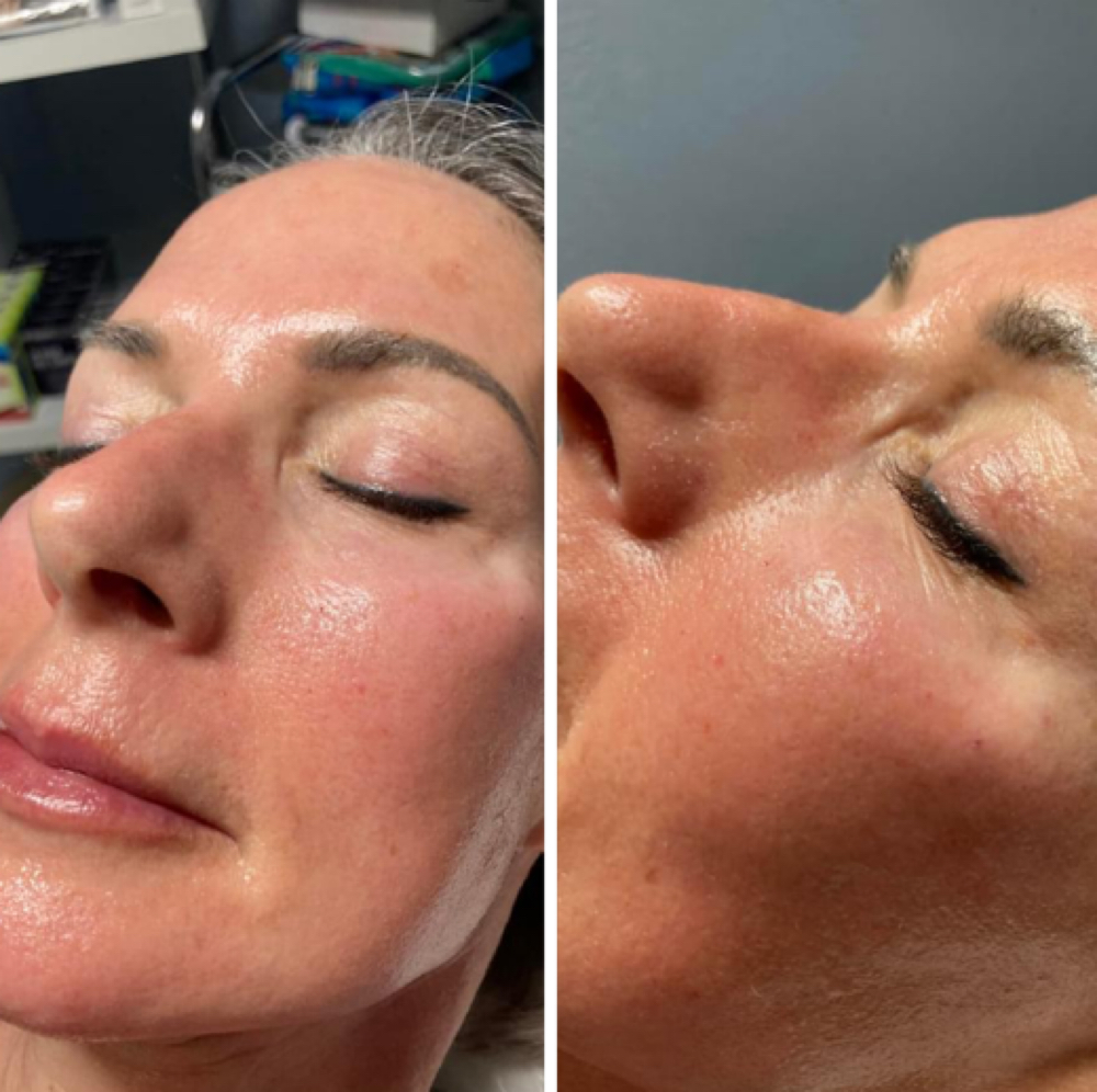 Microneedling at Allure Aesthetics & Wellness Studio in Midwest City, OK
