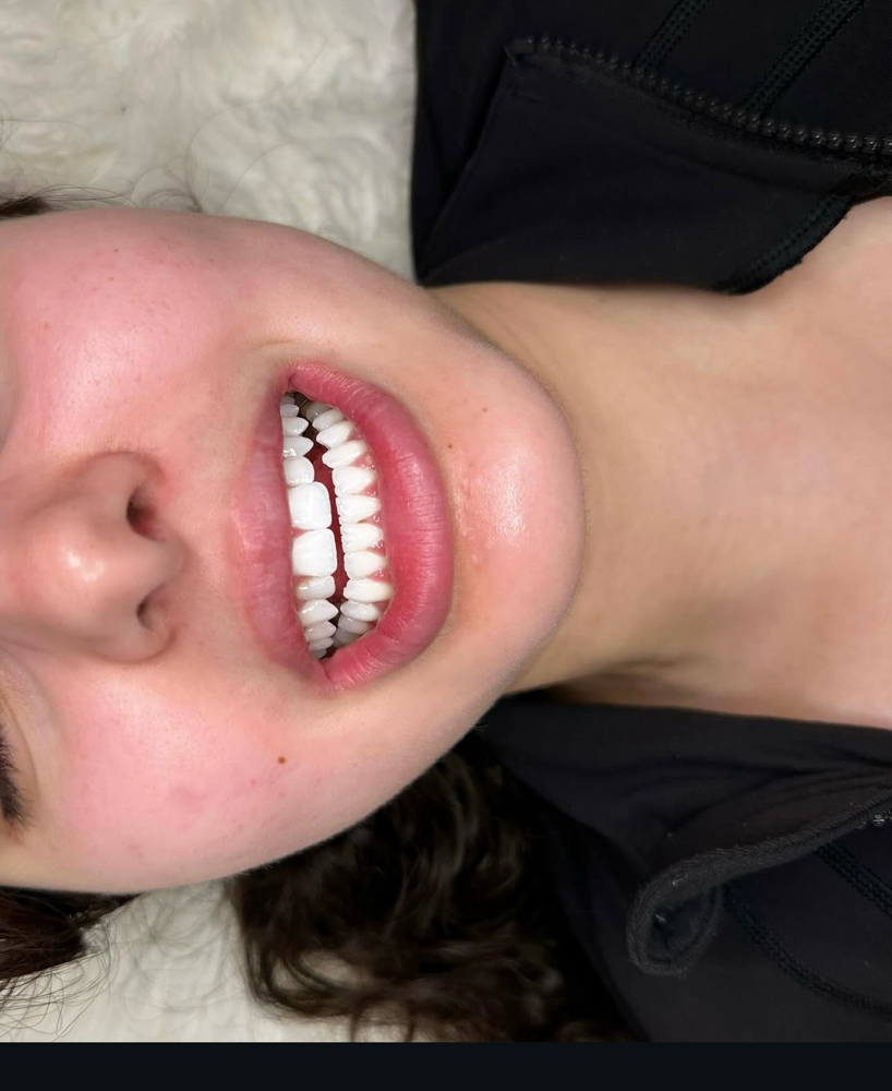 Pro Teeth Whitening