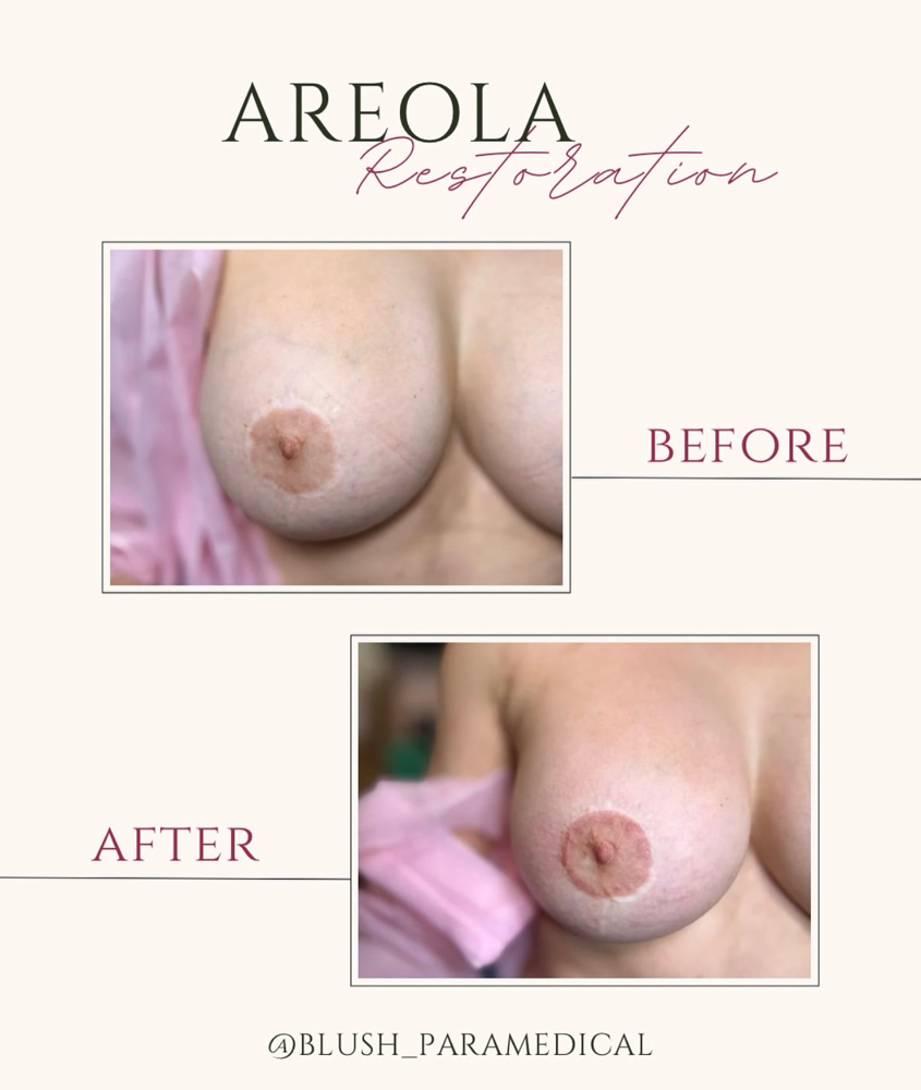 Areola Restoration