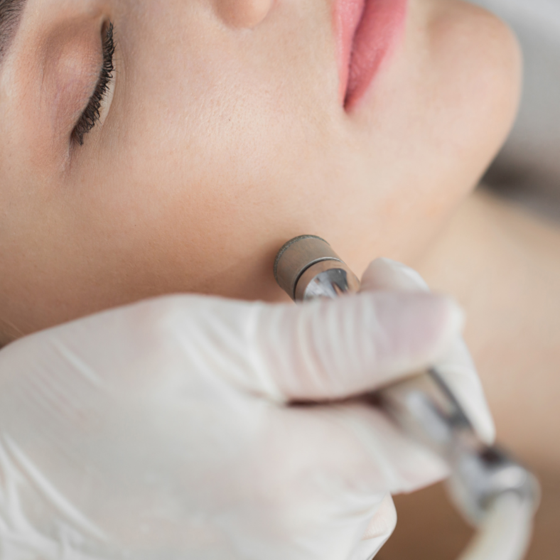 Microdermabrasion Facial at Pink Feather Esthetics in Peekskill, NY