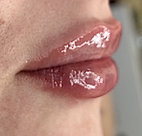 Natural Lip Filler