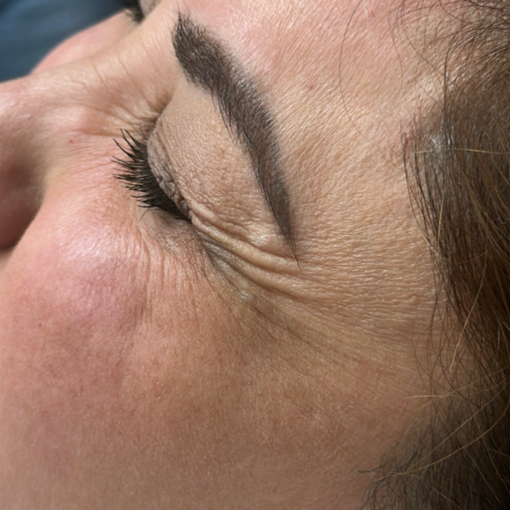 Botulinum Toxin/ Toxina Botulinica at Kimspa&beauty in Dallas, TX