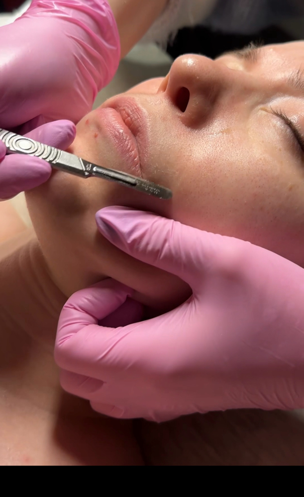 Dermaplane Treatment