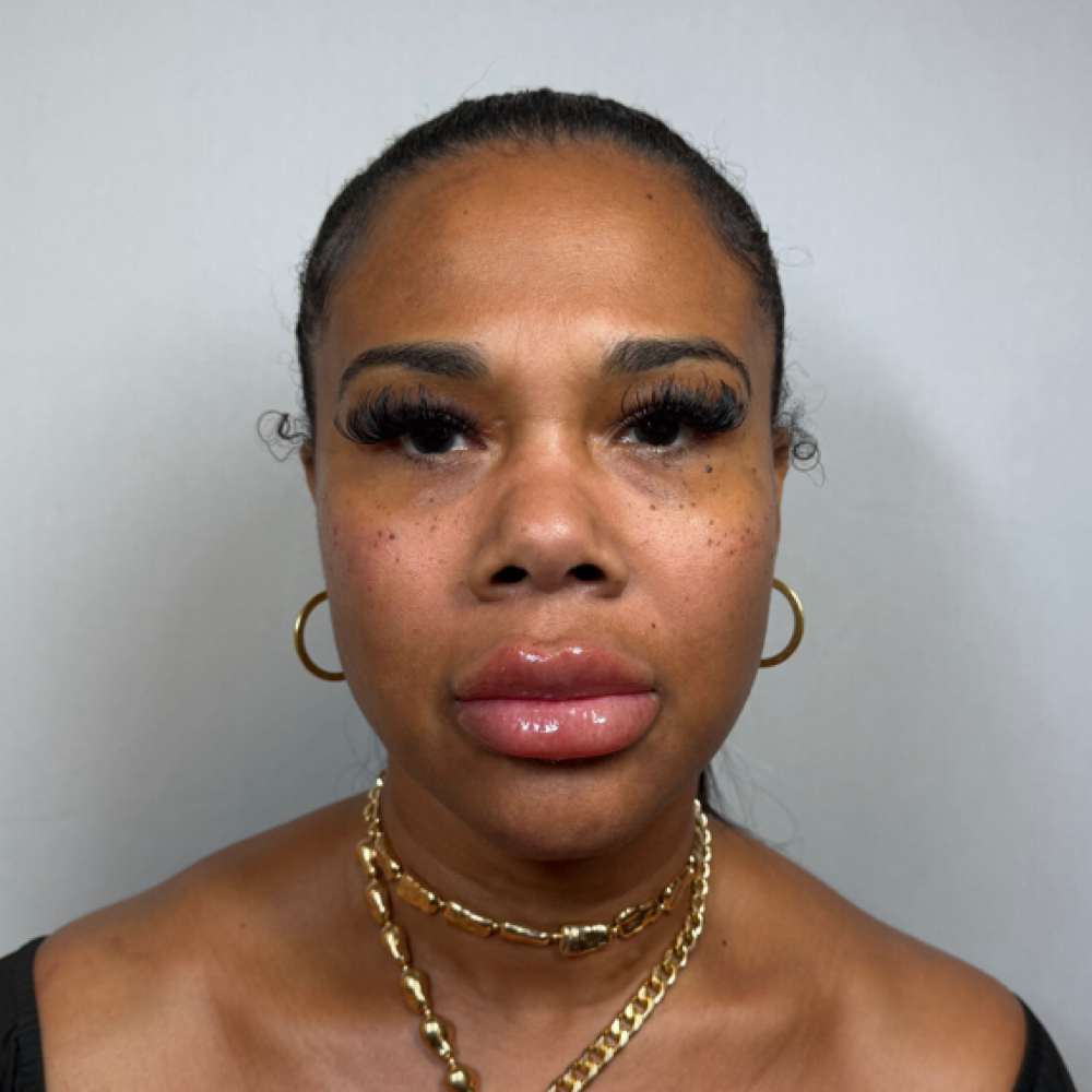 Cheek Filler at Eluxy Aesthetics in Arlington, TX