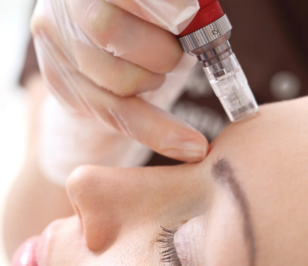 Microneedling Facial
