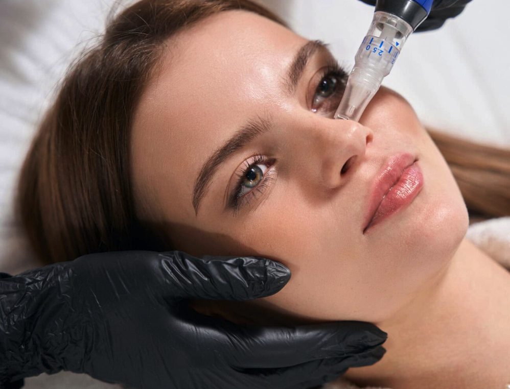 SkinPen with Dermaplane at Brandy's Beauty Bar SRQ in Sarasota, FL