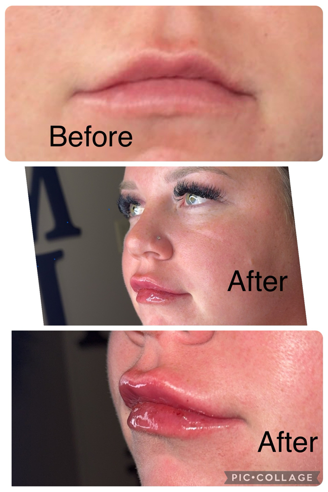 Full Syringe ( Lip filler )