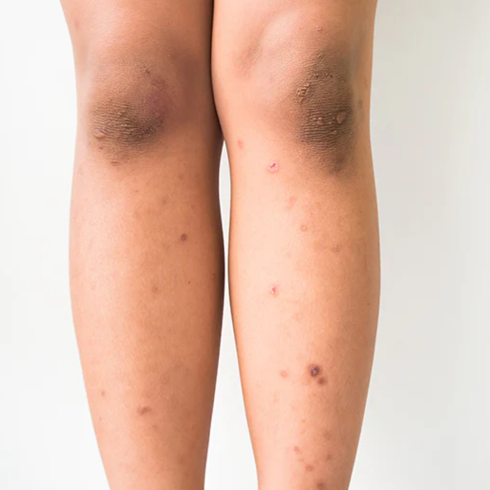 Leg Hyperpigmentation Treatment at Queen Beauty By Lizbette in Cape May Court House, NJ