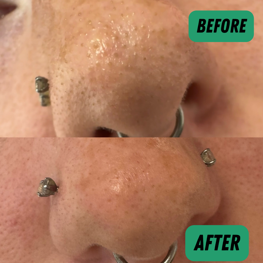 Hydraderm Abrasion