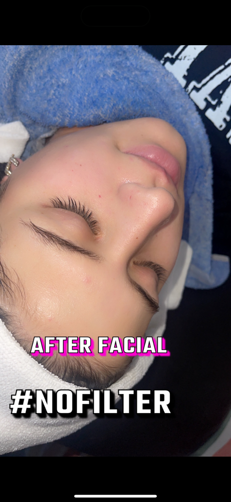 Microdermabrasion Facial