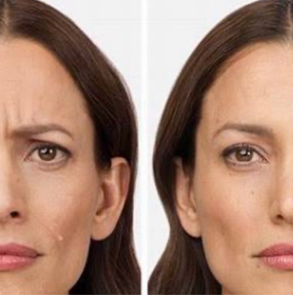 Full Upper Face Botox at Flawless Spa & Beauty in Fort Worth, TX