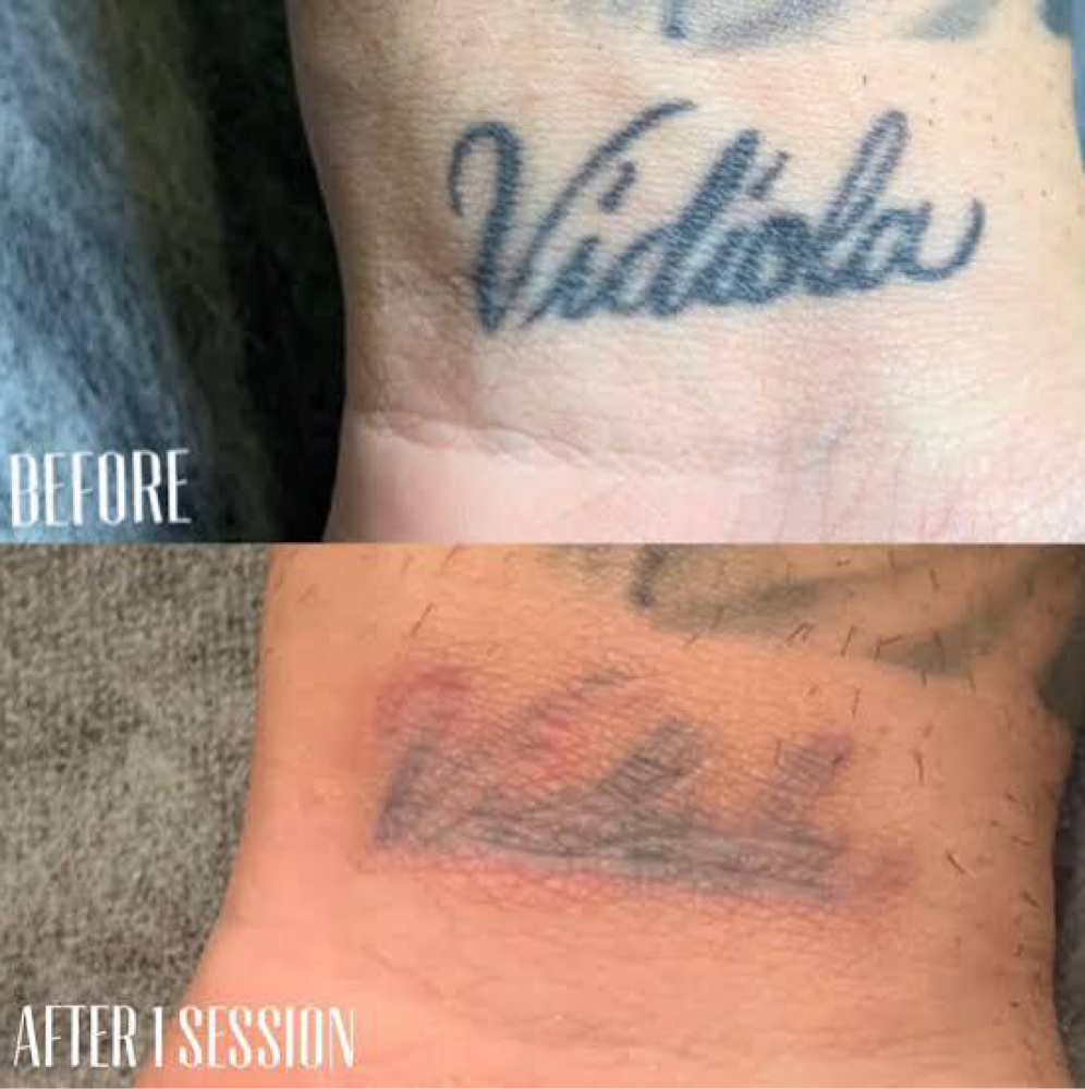 Saline Tattoo Removal