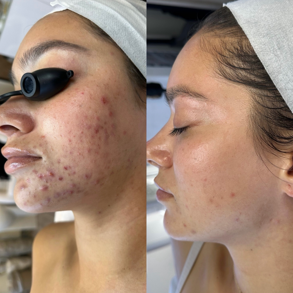 NEW ACNE CLIENT Consult & Treatment at CYNC Beauty in Long Beach, CA