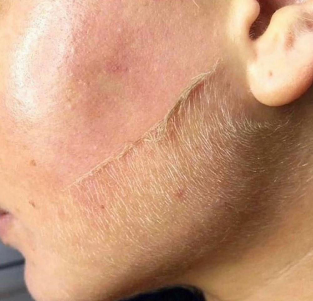 Exfoliacíon Profunda