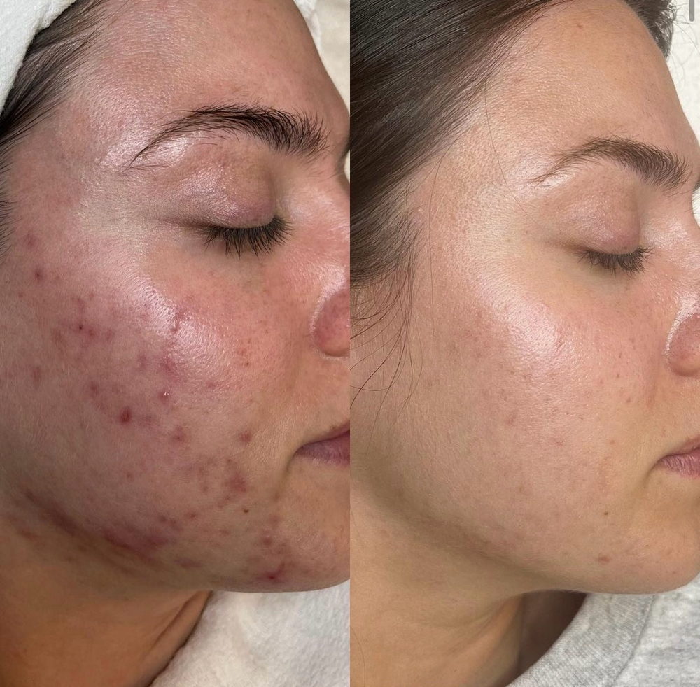 Acne Peel