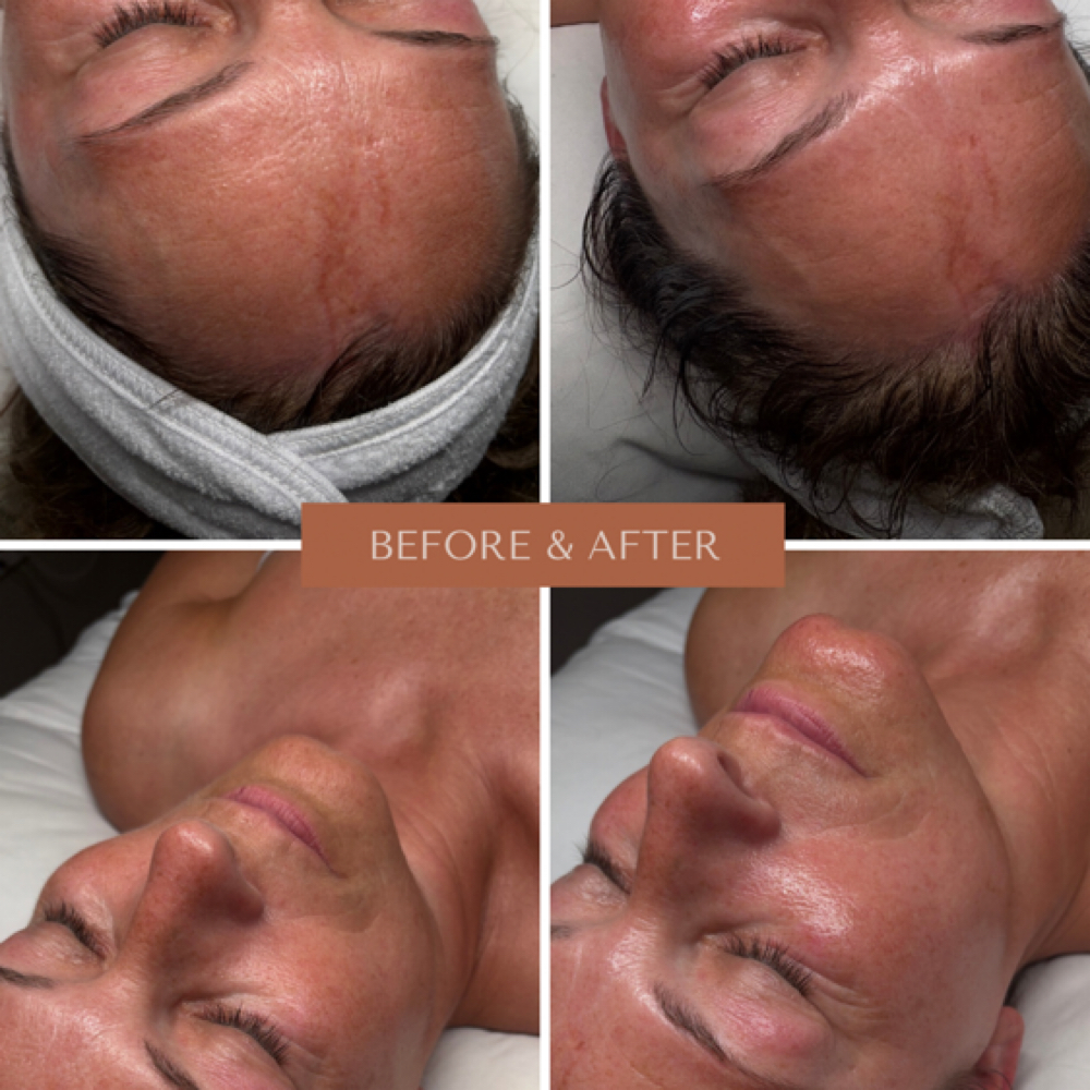 Hydroglow Boost Facial Upgrade at Aesthetics by Abby in Alliance, OH