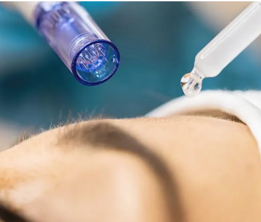 SkinPen Microneedling With PRP