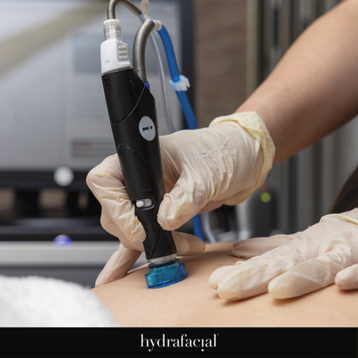 Hydrafacial Back Treatment