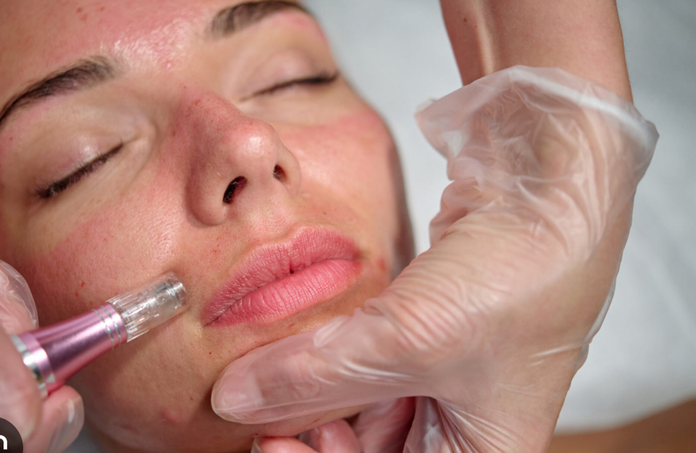 Microneedling at Aesthetic Lash Glow in Of Appointment, AZ