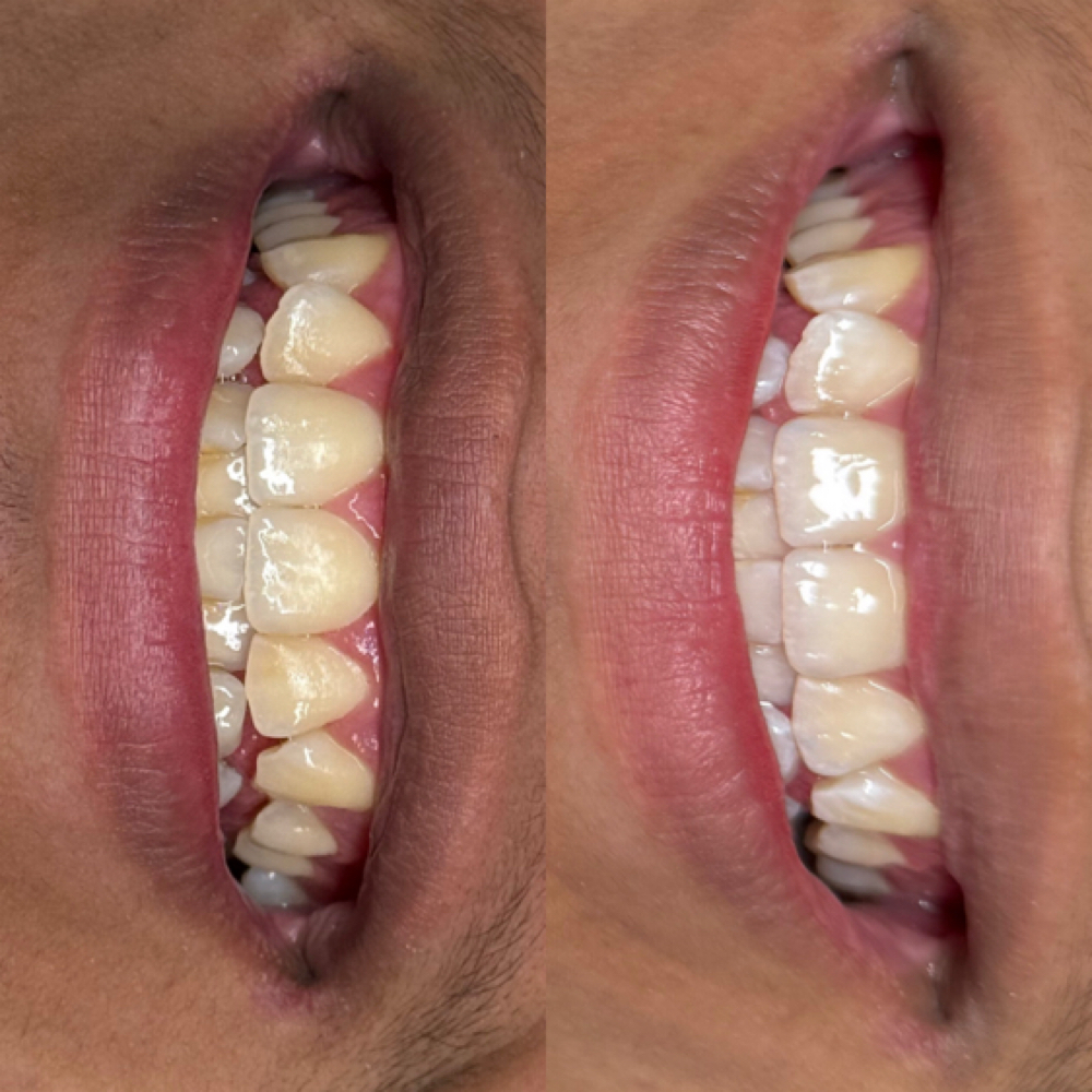 30 Minute Teeth Whitening Session at Elysian Beauty in Chicago, IL
