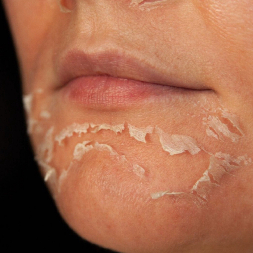 The Skin Renewal Peel at Nyah Simone Spa in Garden City, NY