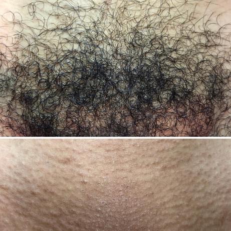 5+ Week Brazilian