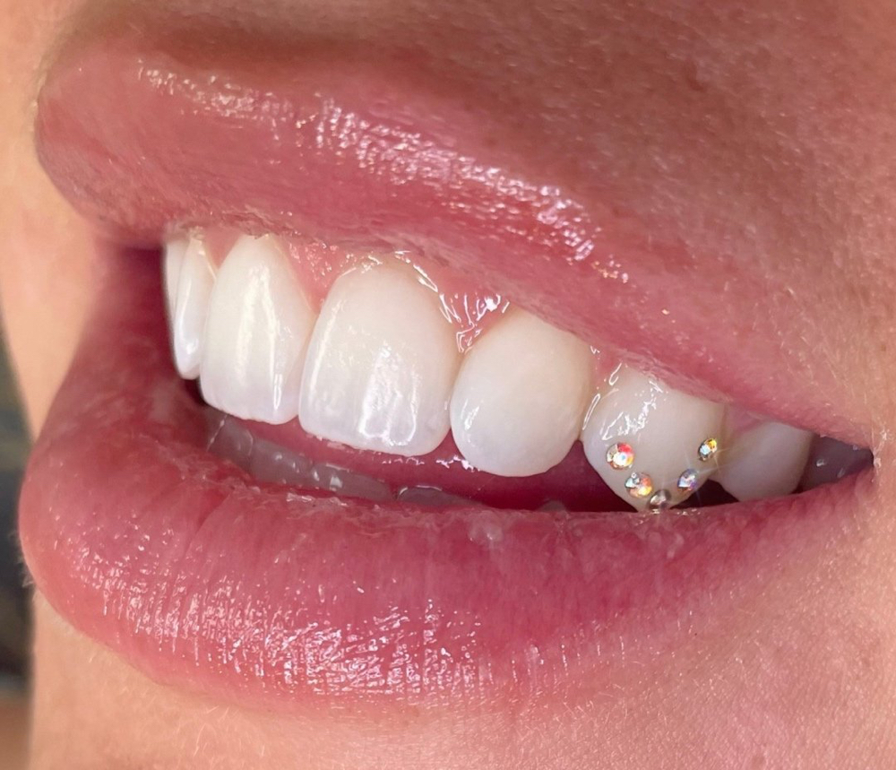 Tooth Gems