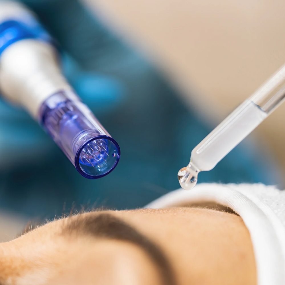 MICRO-NEEDLING