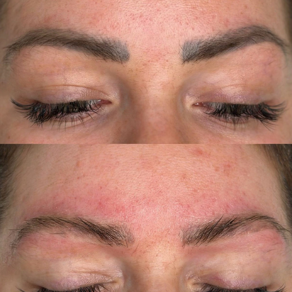 Saline Removal at BrowHaus by Anh in Hermosa Beach, CA