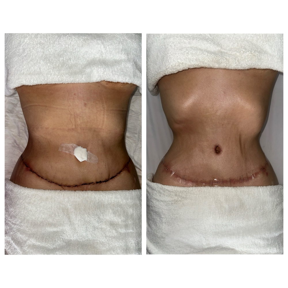 Post - Op Lymphatic Massage