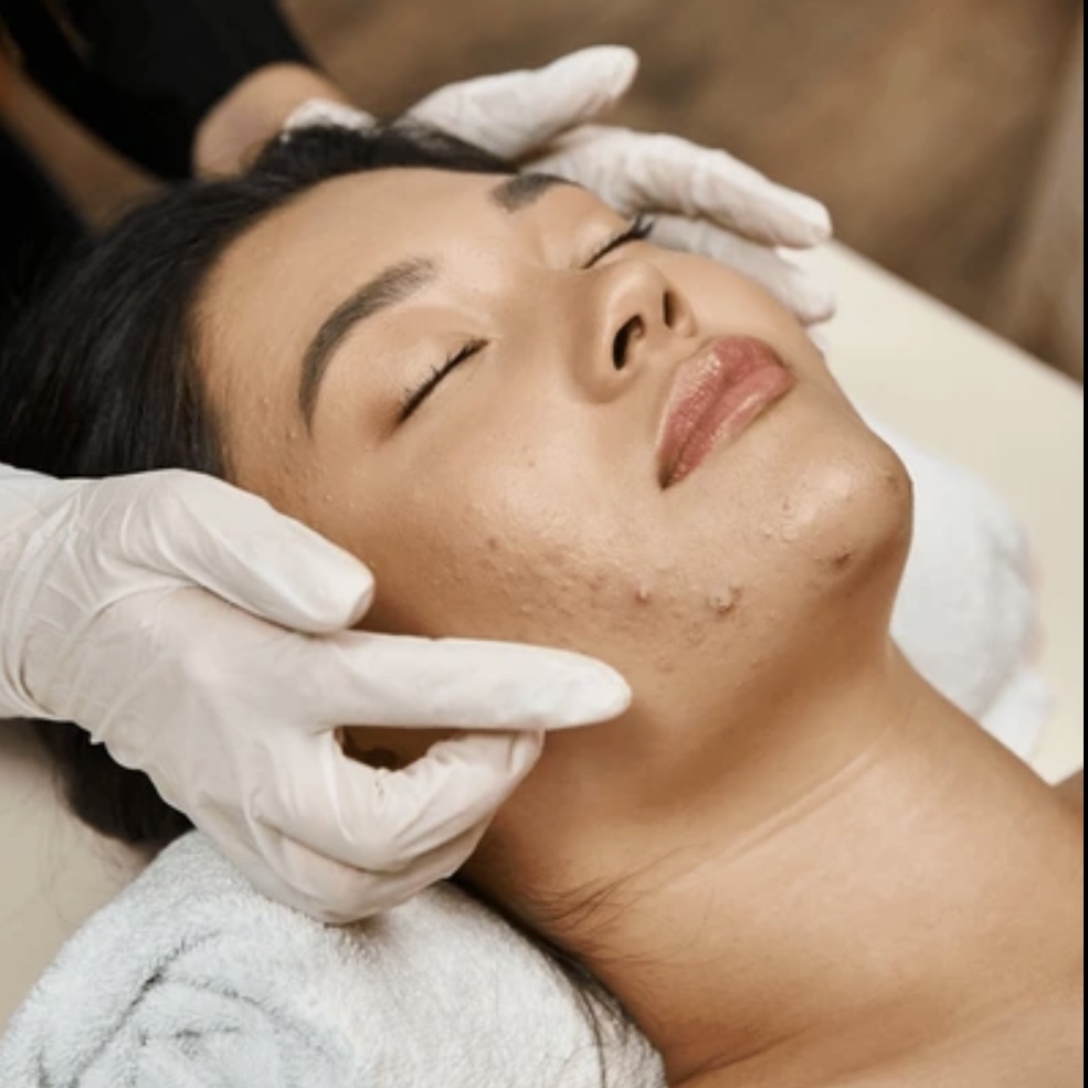 Acne Facial