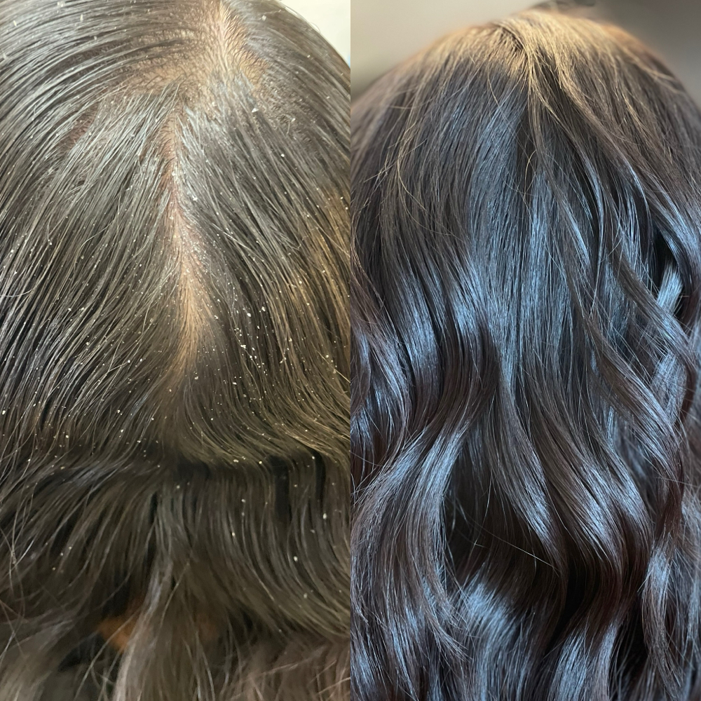 Scalp Exfoliation Treatment