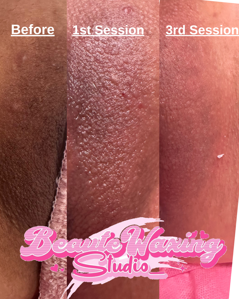 Anus Or Labia (Only) Skin Lightenin