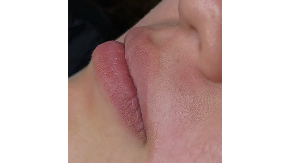 Upper Lip Hair Removal