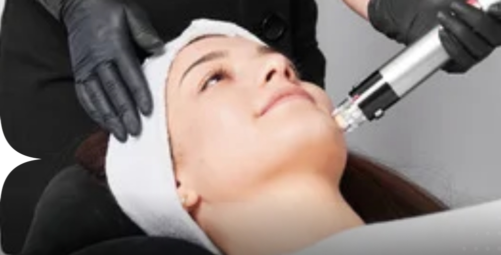 Micro-Needling