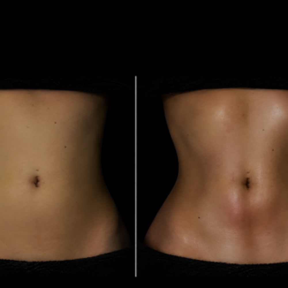 10 Post-Op Lymph Massages at Vida Wellness in San Diego, CA