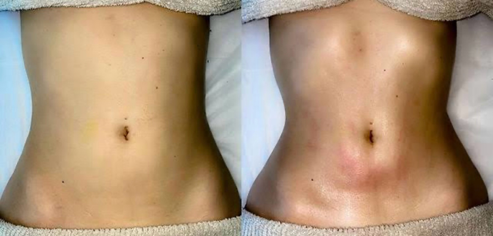 10 Post-Op Lymph Massages