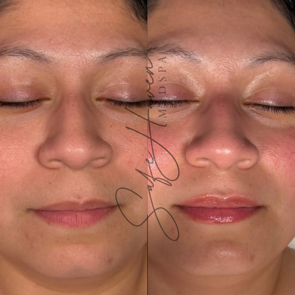 Dermaplaning at Safe Haven MedSpa in McAllen, TX