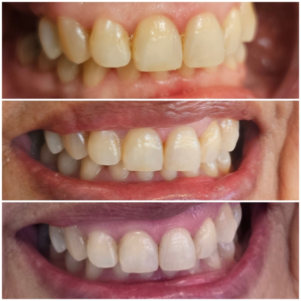 Teeth Whitening at Rooted Rituals Esthetics Co. in North Ogden, UT