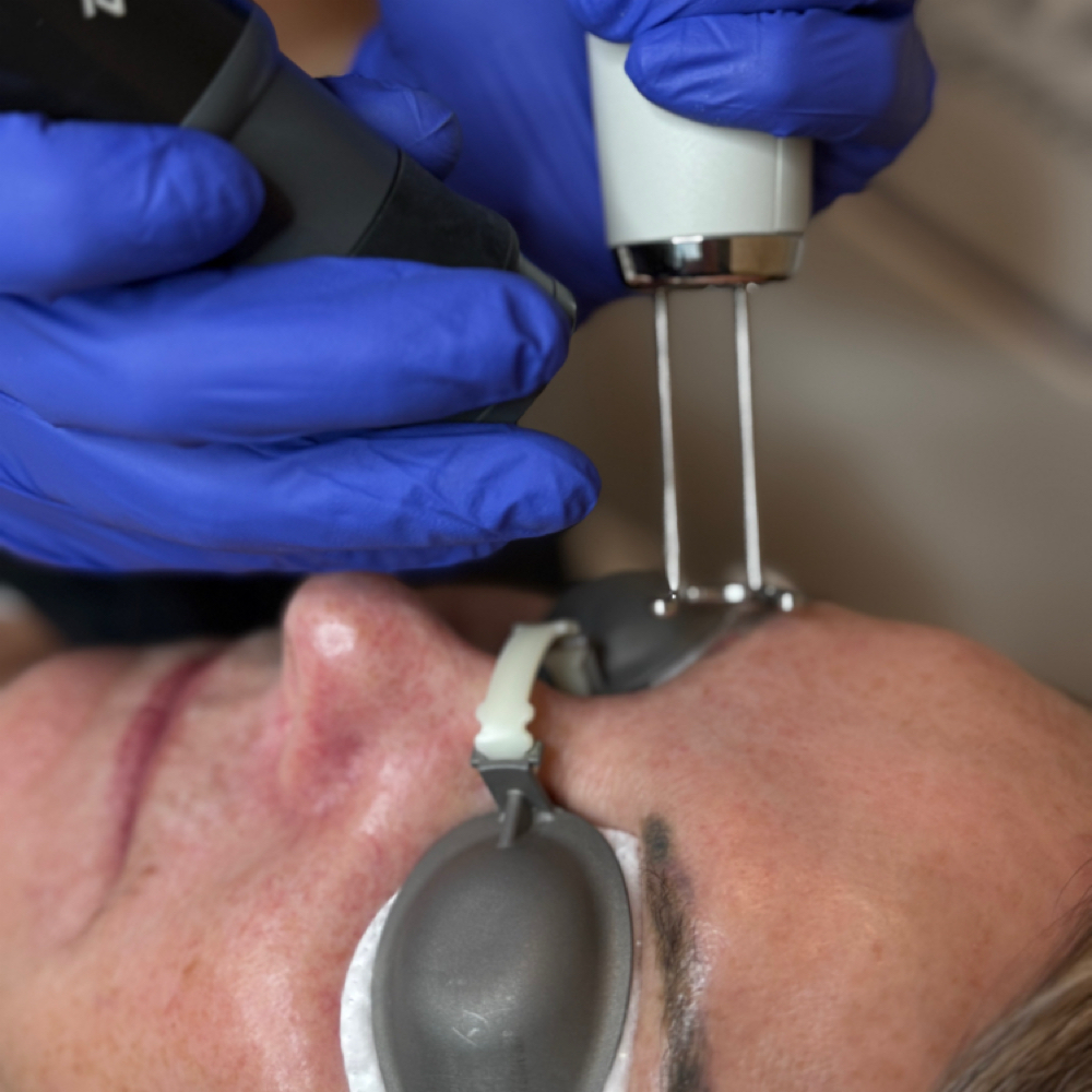 Eyebrow Tattoo Removal at REVIVE Tattoo Removal & Skin Health in Lakewood Ranch, FL