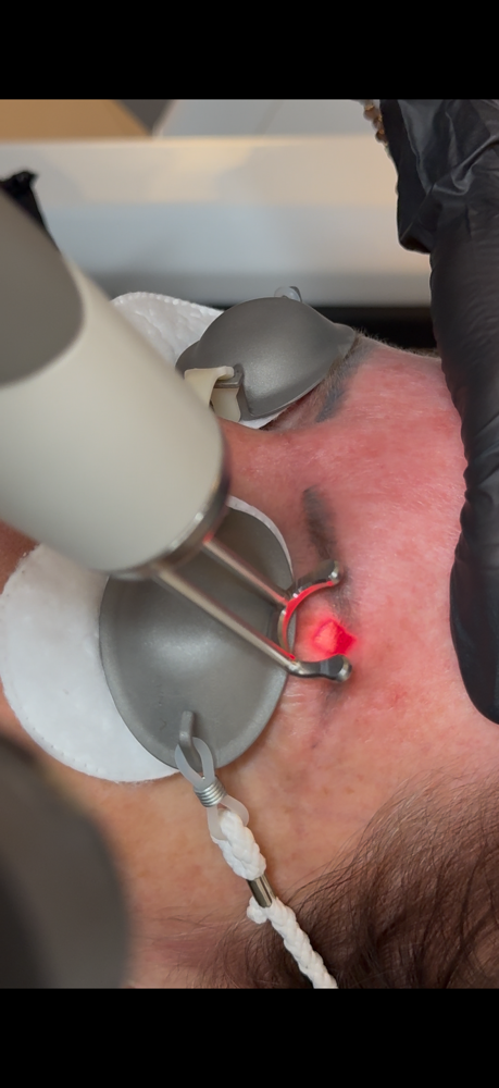 Eyebrow Tattoo Removal